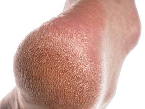 Closeup of a person with dry skin on heel