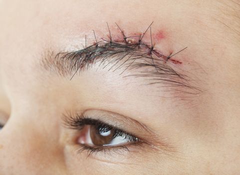 A gash above the eyebrow that has just received 7 stitches to close it up.
