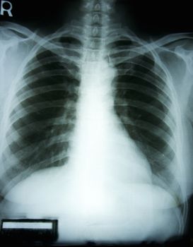 X-ray film of a woman chest with the black background.