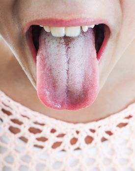 Young female person protruding white plaque on tongue