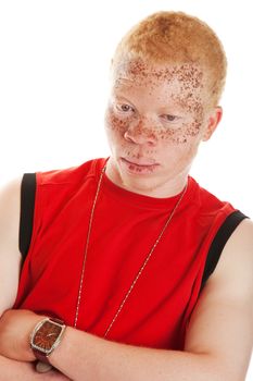 Portrait of an African albino man with heavily freckled lips and skin.