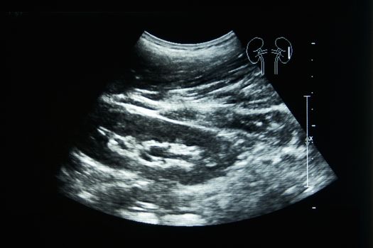 Ultrasound film of a woman left kidney with the black background.
