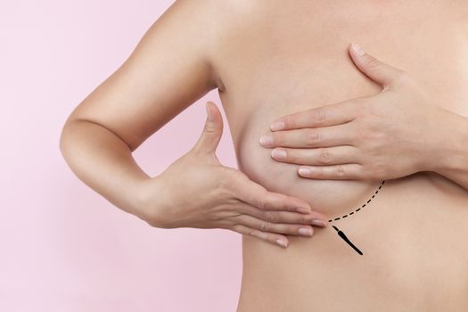 Breast augmentation. Plastic surgery and Aesthetic medicine. Beautiful woman gently touching her breast with marked dotted line ready for surgery. Breast augmentation.