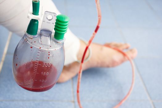 vacuum bottle for draining blood from leg patient