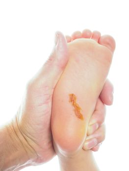 Child with a long cut under foot on heel with antiseptic, being examinated towards white