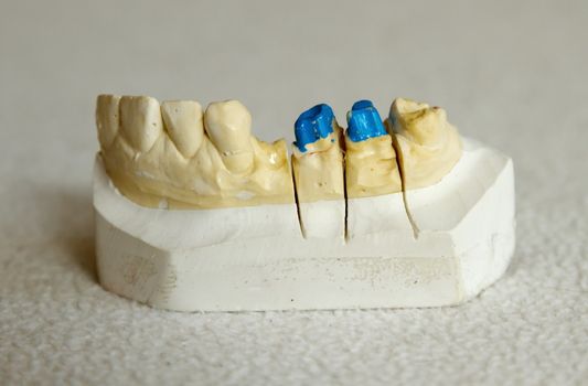 Zirconium or porcelain crown preparation on cast model