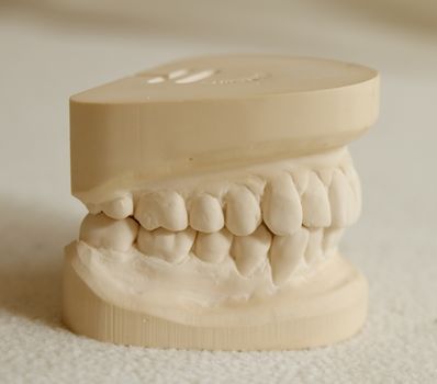 Dental gypsum model mould of teeth in plaster