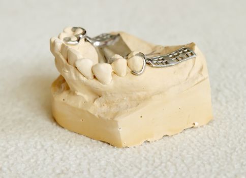 Dental metal framework for partial denture on cast model