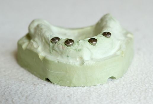 Cast model with four implant preparations on upper jaw