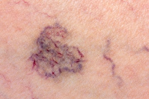 Close-up of skin with varicose veins