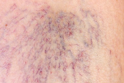 Close-up of dermis with varicose veins