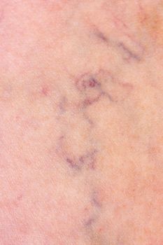 Skin with varicose veins