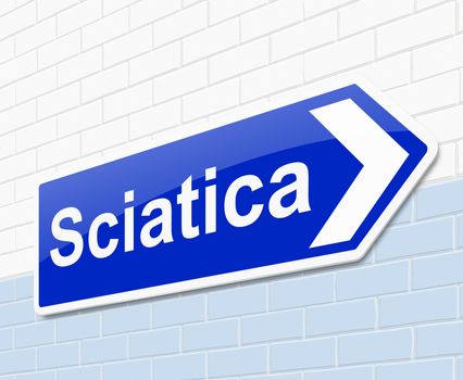 Illustration depicting a sign with a sciatica concept.