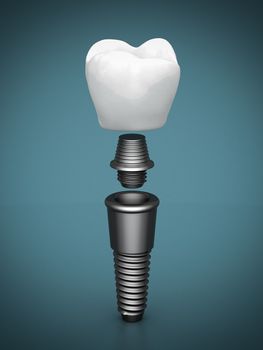Dental implants on a beautiful blue background