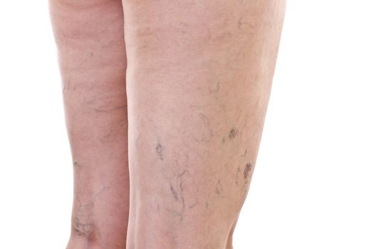 Legs with varicose veins