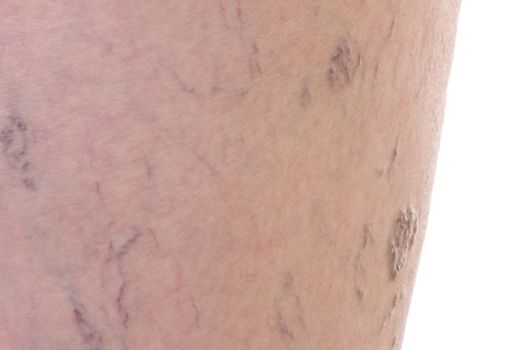 Close-up of dermis with varicose veins