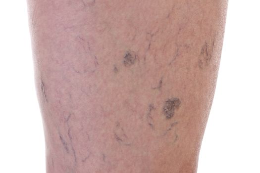 Leg full of varicose veins