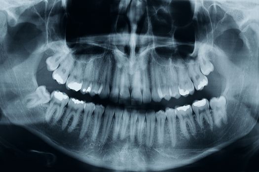 Dental xray shows 3 wisdom tooths. there is one critical in the lower part of the picture, this is a high resolution, photo