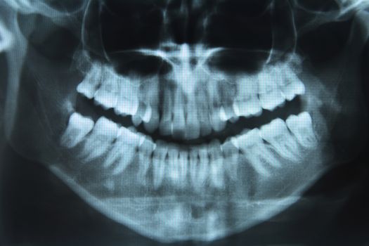 A dental picture of a woman mouth made by an xray, high resolution image 24 mp, the xray itself wasn't the best made quality