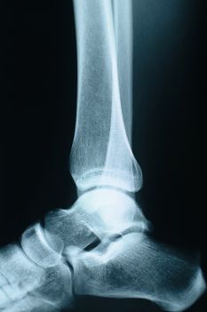 Female ankle xray made in a  hospital.