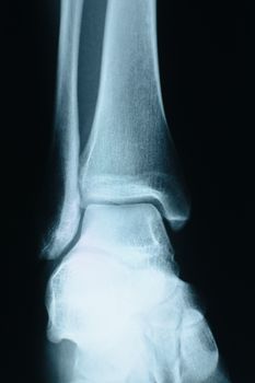 Female heel xray, hi resolution shot made in a hospital.