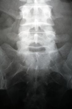 X-ray of the spinal column and pelvis of a woman