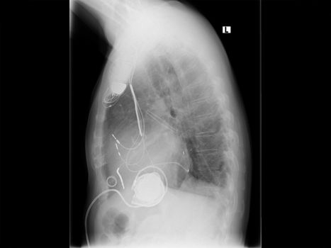 X-ray image of the breast. Vergößertes heart with dilated cardiomyopathy. With implanted pacemaker system. Cardiac resynchronization therapy.