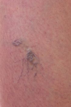 Close-up of skin with varicose veins
