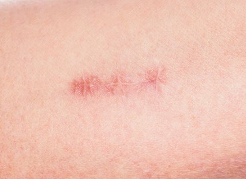 Closeup of redness around healing stitches on skin