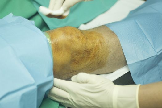 Close-up color photo of a female hospital clinic nurse wearing sterile blue gloves and senior male patient aged 65-70 being cleaned after receiving a an injection of human growth factors in his knee with sterilising liquid covering skin and sterile green hospital bed defocused background.