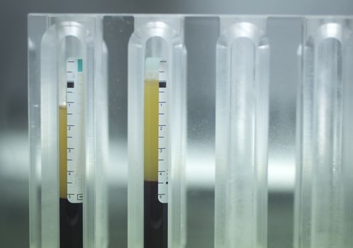 Medical laboratory preparation of human growth factors in hospital clinic for orthopedic surgery and Traumatology rehabilitation treatment with test tubes in sterile environment.