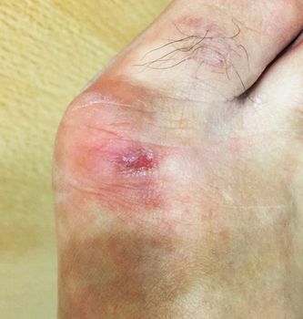 Front foot ulcers caused by friction with shoes, surrounding skin looks a little red.