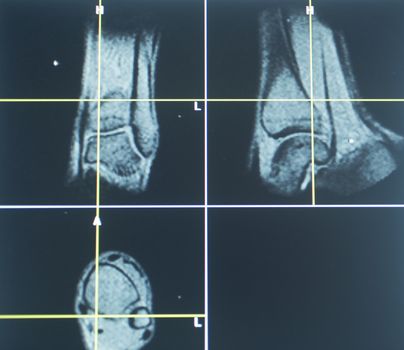 Examination of X-ray MRI CT on computer screen.