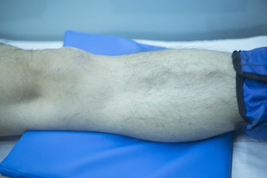 Leg of injured man in physiotherapy treatment in hospital clinic.