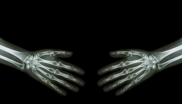 Shake hands . X-ray normal human hands ( blank area at upper side )