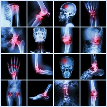 Collection human joint and arthritis and stroke ( skull head neck shoulder chest thorax shoulder arm elbow forearm wrist hand finger palm spine back pelvis thigh knee leg foot ankle toe)