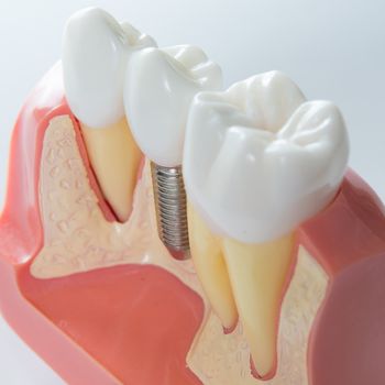 Close up of a Dental  implant model. Selective focus.