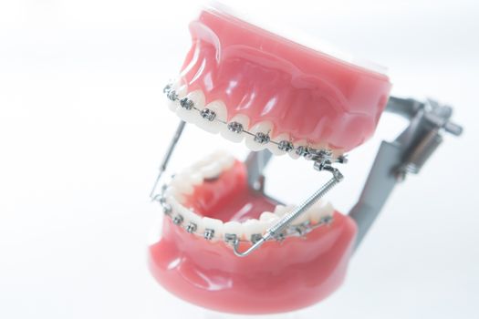 Dental lower jaw bracket braces model on white. Selective focus.