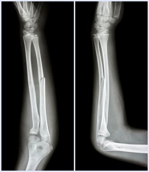 Fracture shaft of ulnar bone ( forearm bone ) : ( front and side view )