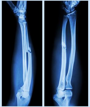 X-ray forearm ( front , side ) : Comminuted fracture shaft of ulnar bone ( forearm bone )