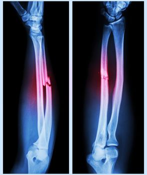 X-ray forearm ( front , side ) : Comminuted fracture shaft of ulnar bone ( forearm bone )