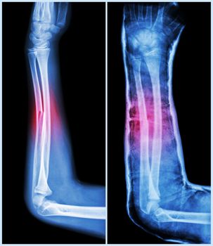 Fracture shaft of ulnar bone ( forearm bone ) : ( Left : pre-treatment , Right : Psot-treatment (splint with cast) )