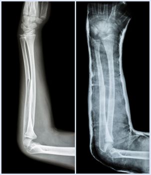 Fracture shaft of ulnar bone ( forearm bone ) : ( Left : pre-treatment , Right : Psot-treatment (splint with cast) )