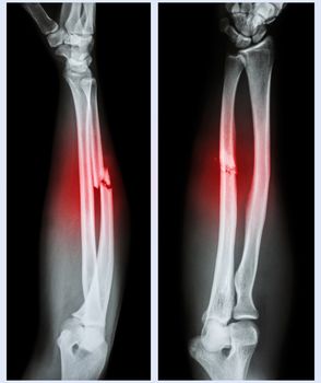 X-ray forearm ( front , side ) : Comminuted fracture shaft of ulnar bone ( forearm bone )