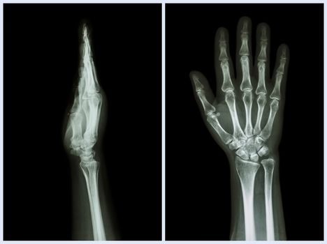 X-Ray Hands ( front & side view ) : Normal human hands