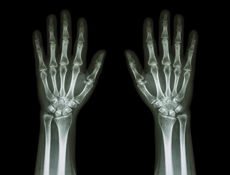 X-Ray Hands ( front view ) : Normal human hands