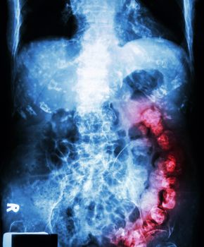 " Constipation " ( X-ray abdomen of old man : a lot of feces in large bowel and calcified at rib )