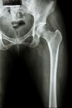 X-ray normal pelvis & hip joint