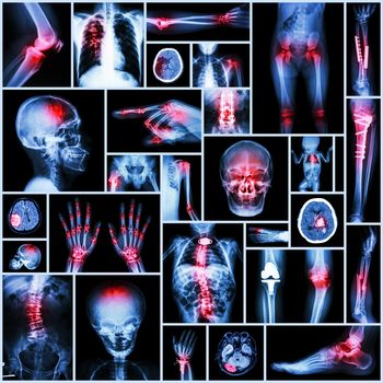 Collection X-ray part of human,Orthopedic operation,Multiple disease (Fracture,Gout,Rheumatoid arthritis,Osteoarthritis knee,Stroke,Brain tumor,Scoliosis,Tuberculosis, etc.)