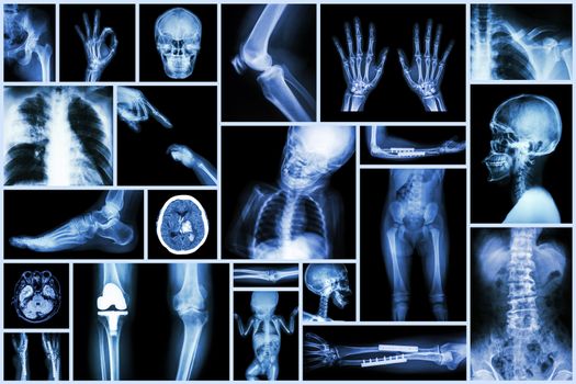 Collection X-ray multiple part of human & Orthopedic surgery & Multiple disease (Osteoarthritis knee,spondylosis,Stroke,Fracture bone,Pulmonary tuberculosis, etc)